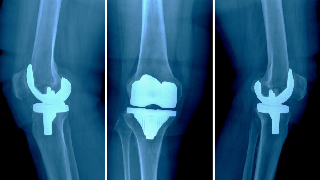 Why Does Knee Pain Occur After Femur Rod Surgery?